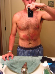 Check out the damage. Even my nips are burnt. 